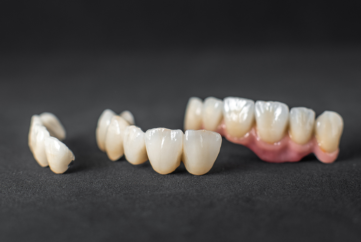 Dental Crowns & Bridges