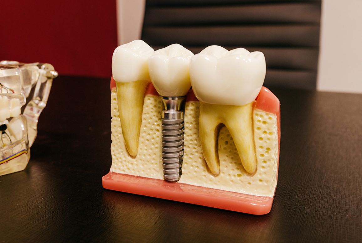 Dental Implants