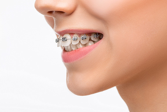 Dental Braces and Aligners