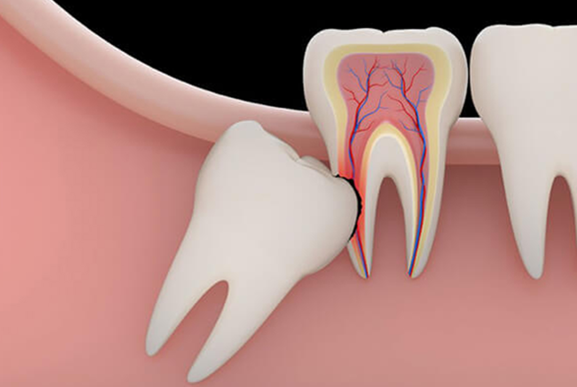 Wisdom Teeth Removal – Boronia And Bayswater