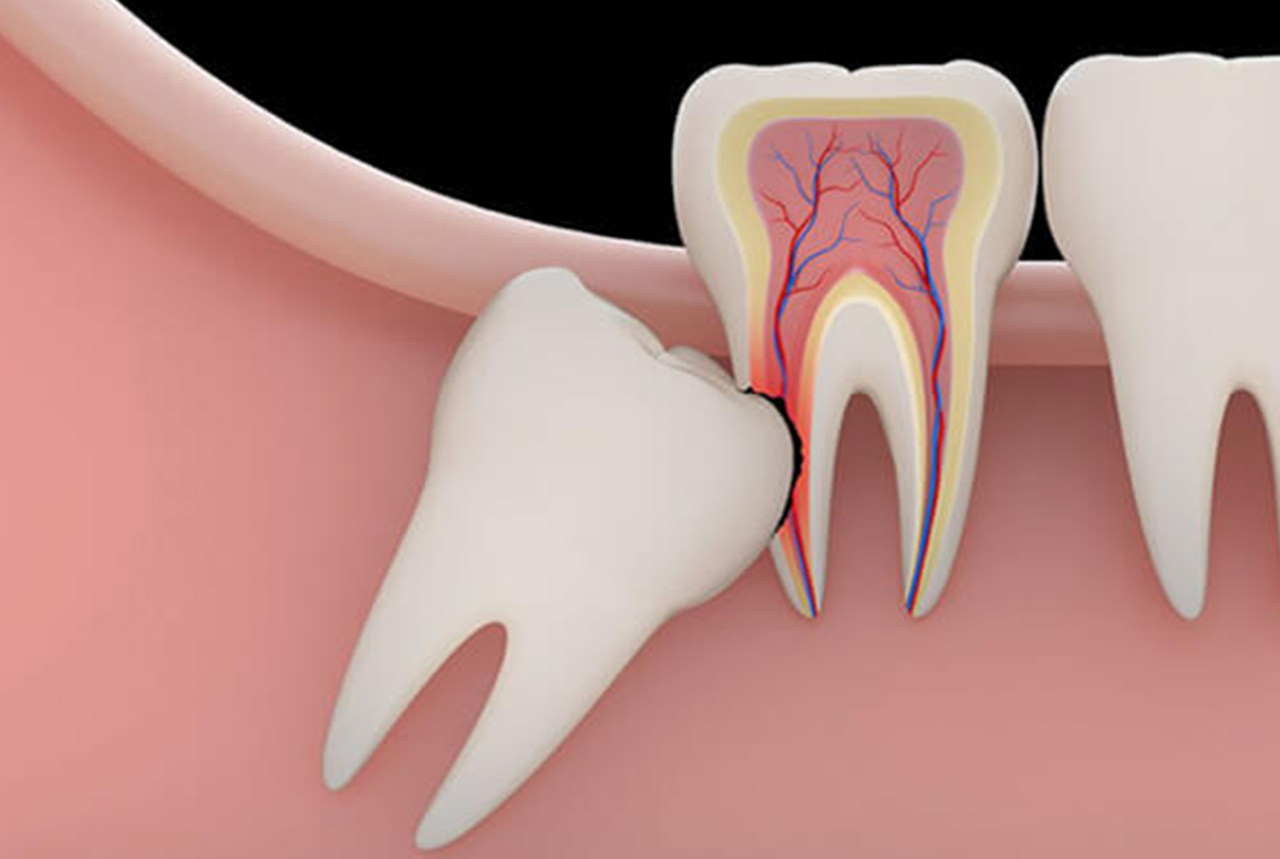 Wisdom Teeth Extraction