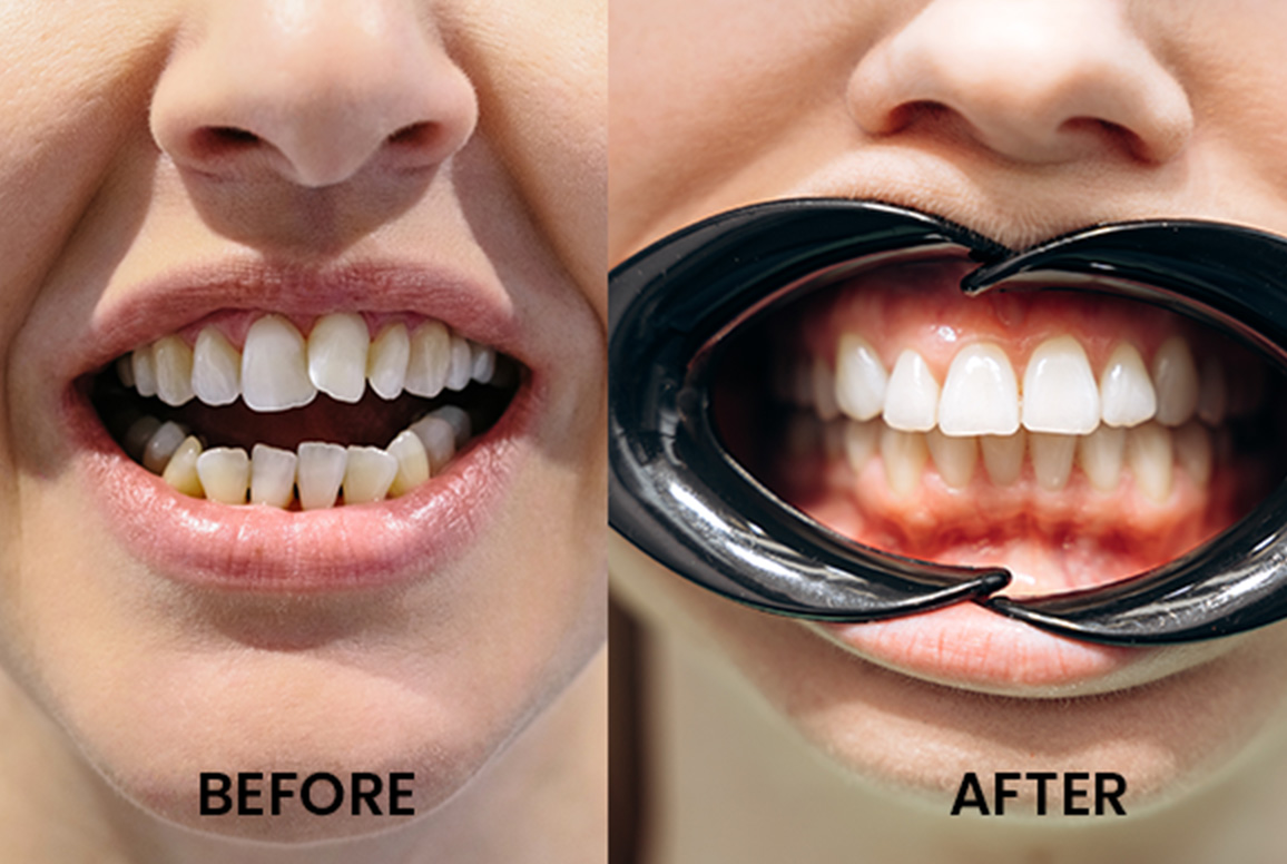 Inman Aligner Teeth Straightening