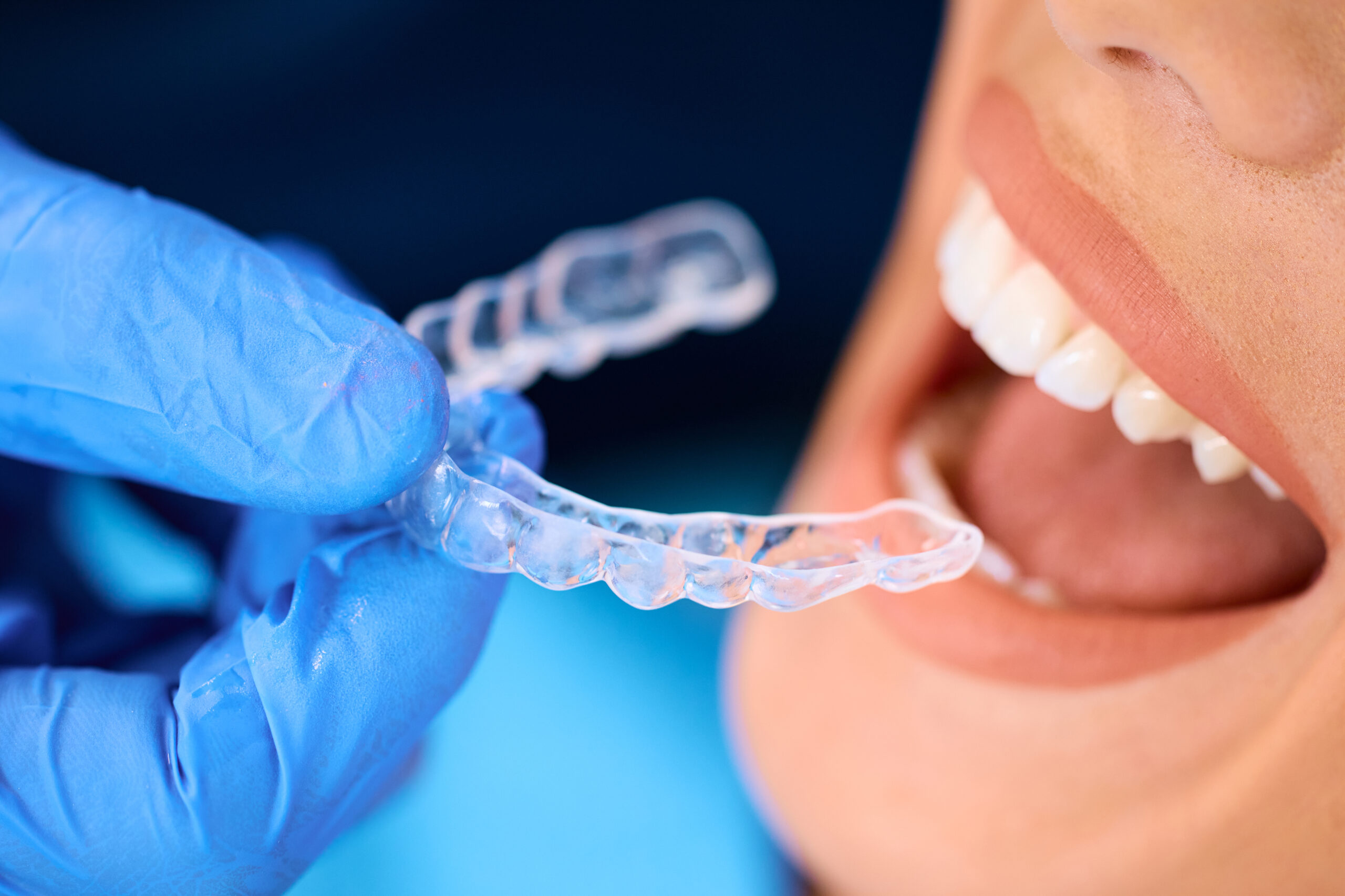 Close up of dentist applying invisible aligner on female patient's teeth at dental clinic
