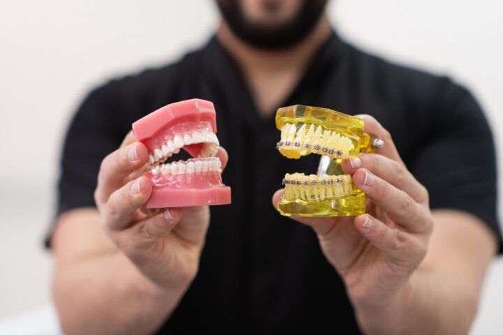 orthodontist showing dental braces and clear aligners in teeth moulds